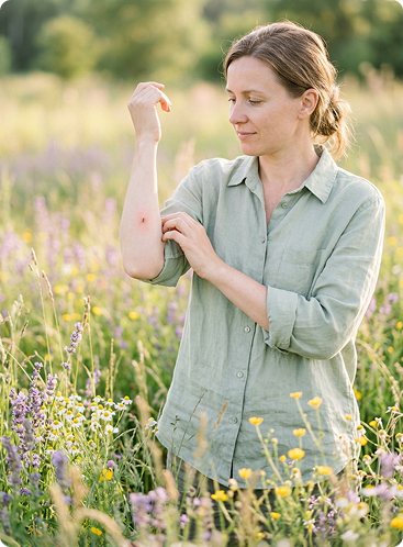 Insect Allergy